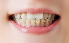 矯正治療の開始